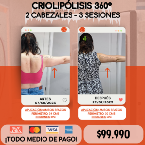 Criolipólisis 360° 2 Cabezales - 3 sesiones