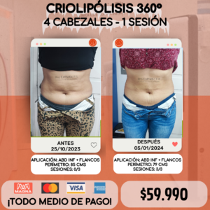 Criolipólisis 360° 4 Cabezales - 1 sesión