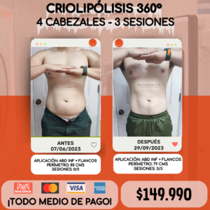 Criolipólisis 360° 4 Cabezales - 3 sesiones