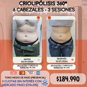 Criolipólisis 360° 6 Cabezales - 3 sesiones
